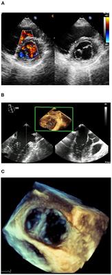 Case report: Echocardiographic diagnosis of double orifice mitral valve in an asymptomatic woman